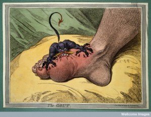 James Gillray, 'The Gout' Credit: Wellcome Library, London. Wellcome Images
